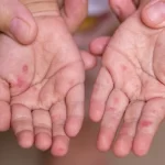 Hand-Foot-Mouth Disease (HFMD): Signs, Symptoms, and Child Care Tips