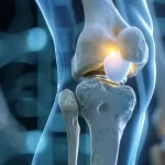 Knee Arthritis Mistakes