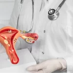 Side Effects After Ovarian Cyst Removal