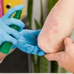 Homeopathic Medicine for Allergy Skin