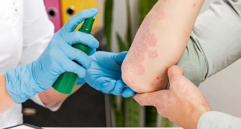 Homeopathic Medicine for Allergy Skin