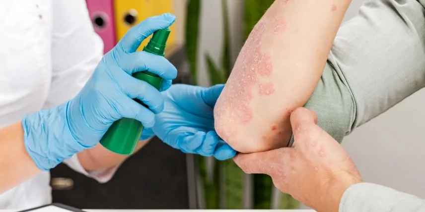 Homeopathic Medicine for Allergy Skin